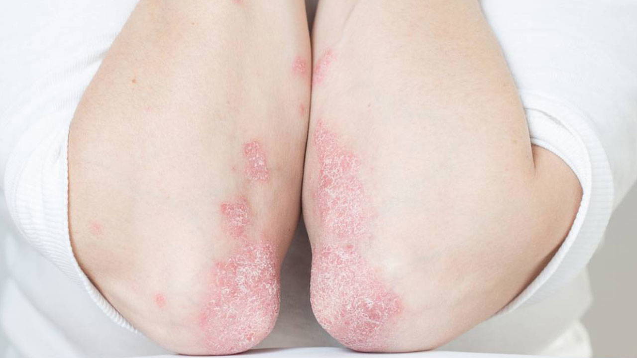 Bir bağışıklık sistemi hastalığı: Lupus kadınlarda 9 kat fazla görülüyor!